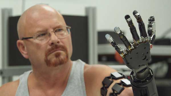 Primer hombre con un brazo artificial funcional