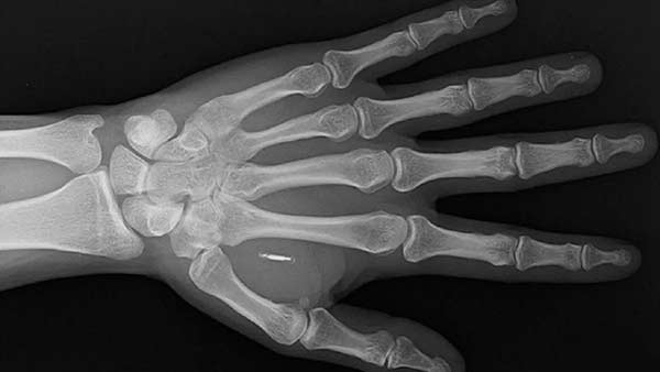 microchip implante de Wallatmor en la mano